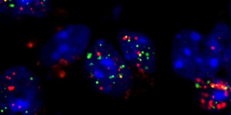 Sandhoff disease gene therapy