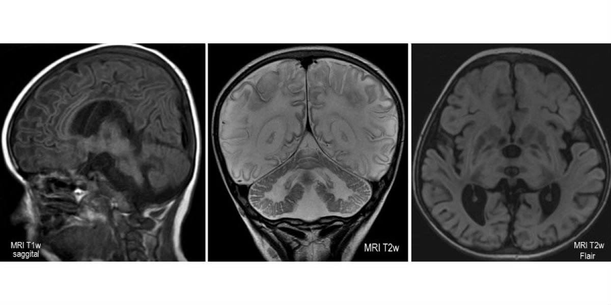 MR scanning images showing severe brain injury in a young girl with Tay-Sachs disease